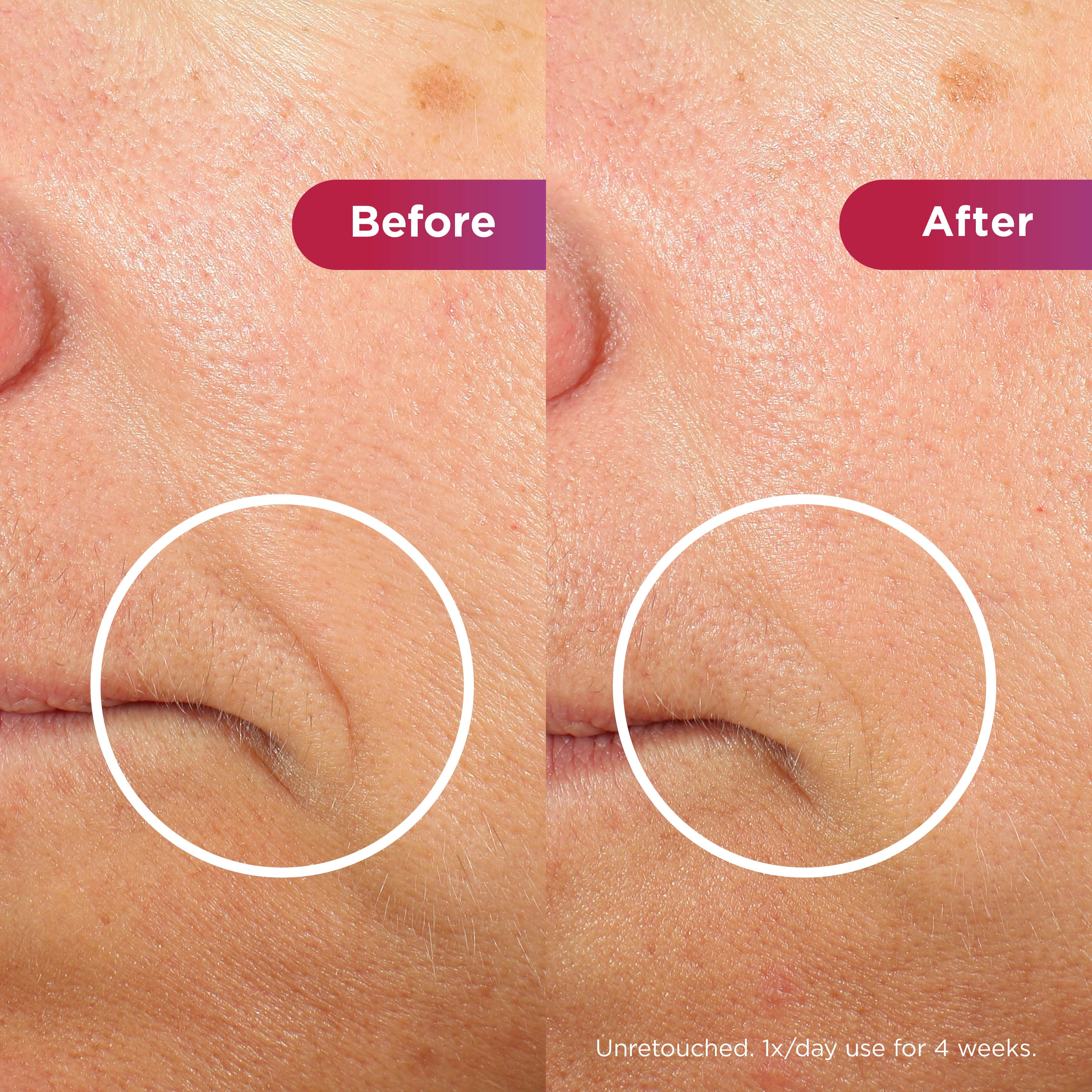 Image of LED Face Mask Before and after results